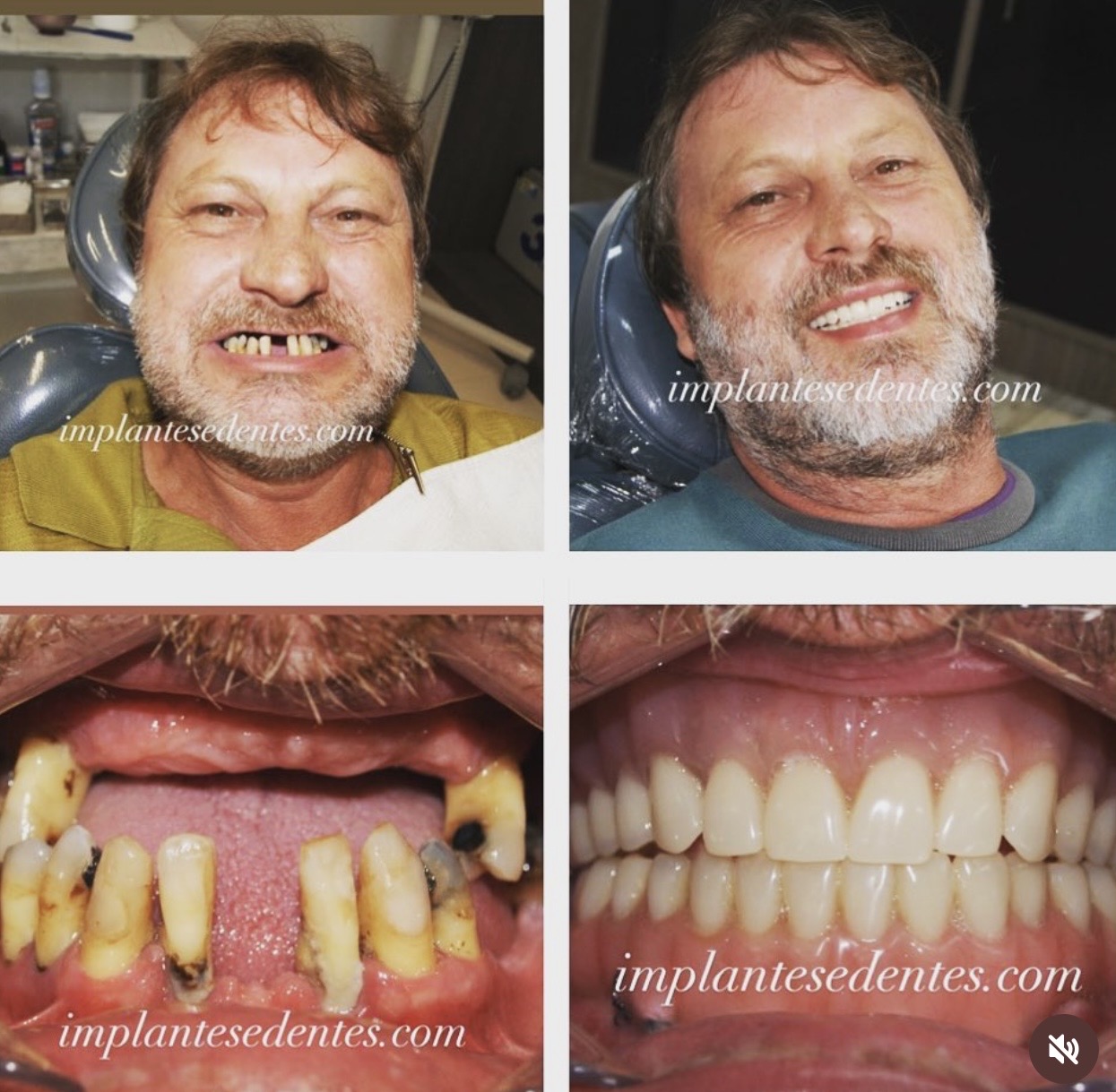 Caso real antes e depois de reabilitação total